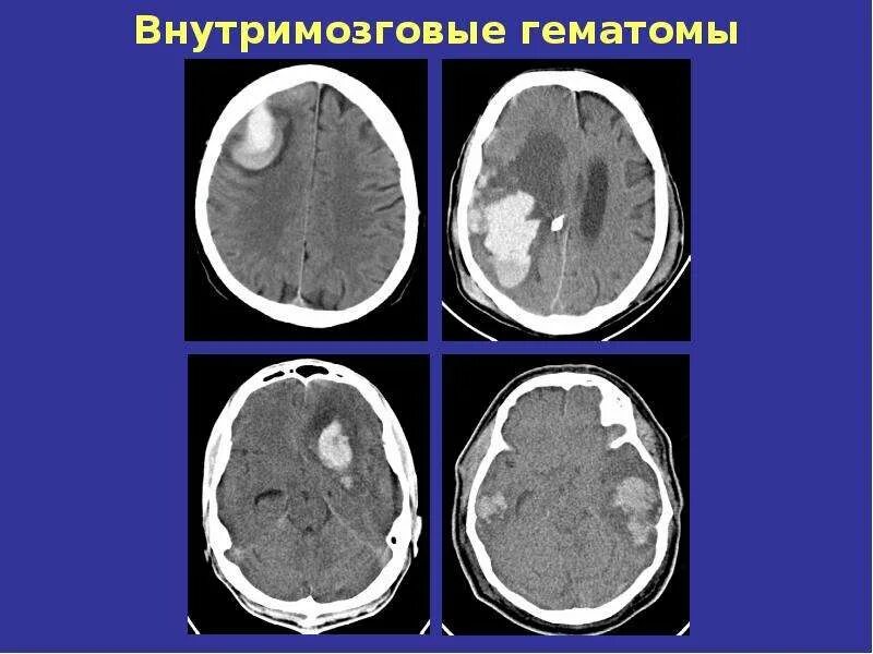 Гематома на МРТ головного мозга покажет ли томография головы гематому