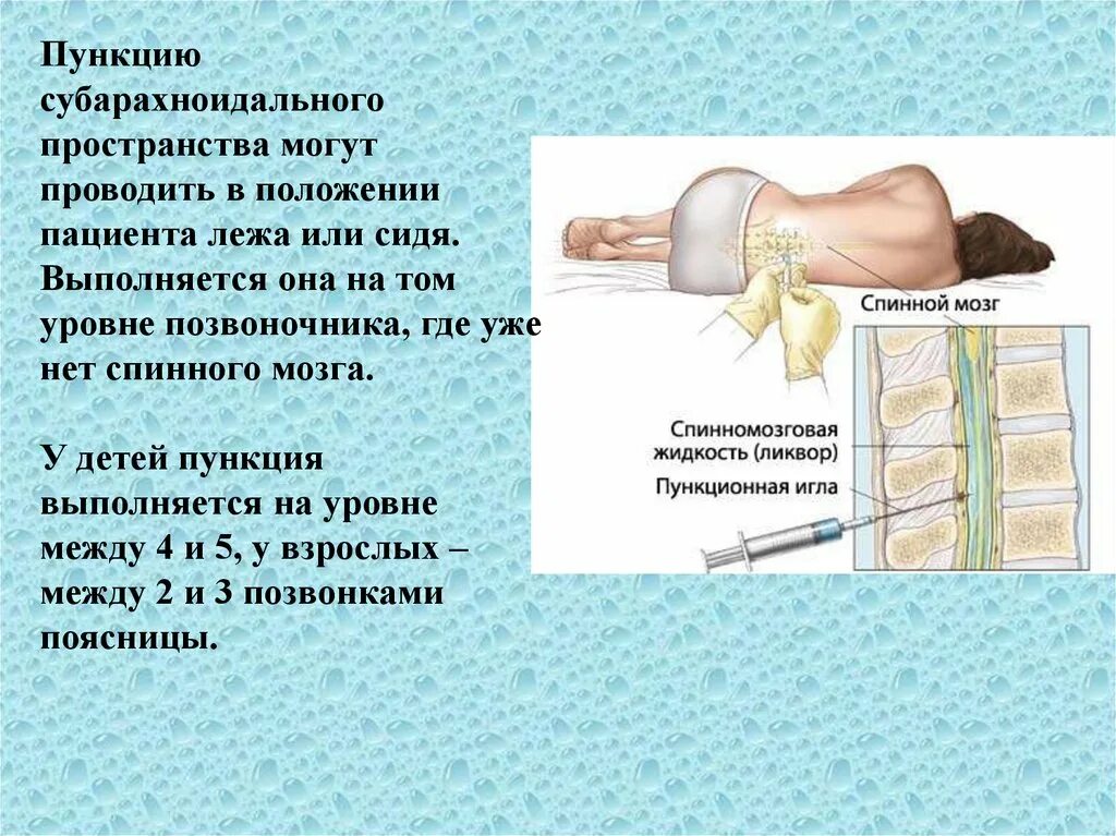 Сколько делают пункцию. Пункция эндолюмбальная. Ликвор спинномозговая пункция. Пункция спинномозгового канала. Спинномозговая пункция проводится на уровне.