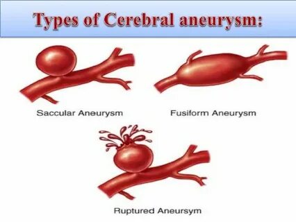 Aneurysm перевод