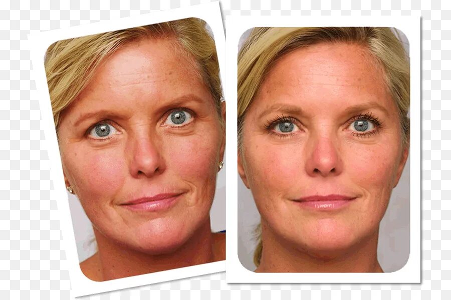 Тиогамма в косметологии. Тиогамма для лица от морщин. Тиогамма в косметологии для лица. Средство с тиоктовой кислотой для лица. Тиогамма для лица до и после.