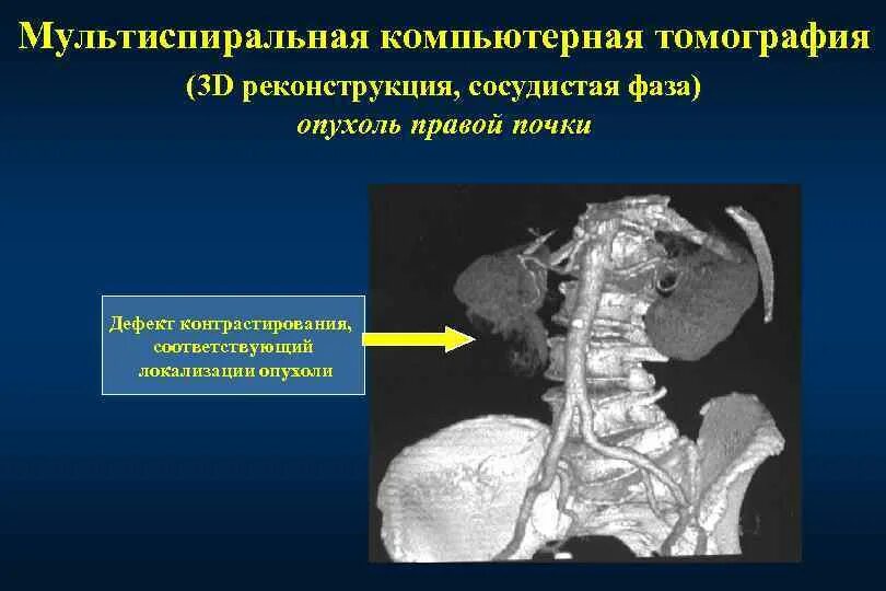 Мультиспиральная компьютерная томография. Компьютерная томография почек. Мультиспиральная кт опухоли.