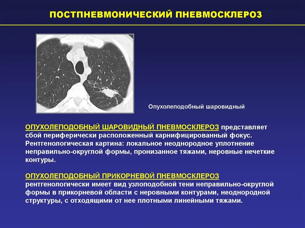 Пневмосклероз кт признаки. Пневмосклероз легких кт. Постпневмонический фиброз на кт. Изменения базальных отделов легких