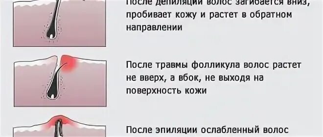 Избавиться от волос навсегда мужчинам. Вросшие волосы после эпиляции. Вросший волос в интимной зоне.