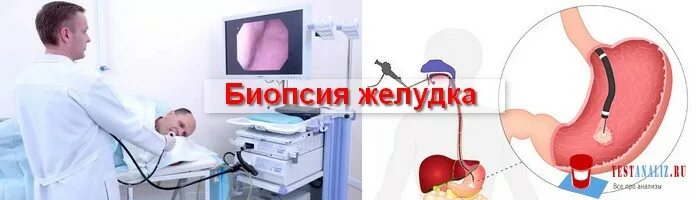 Биоптат кишки. ФГДС взятие биопсии желудка. Биопсия при ФГДС желудка что это такое.