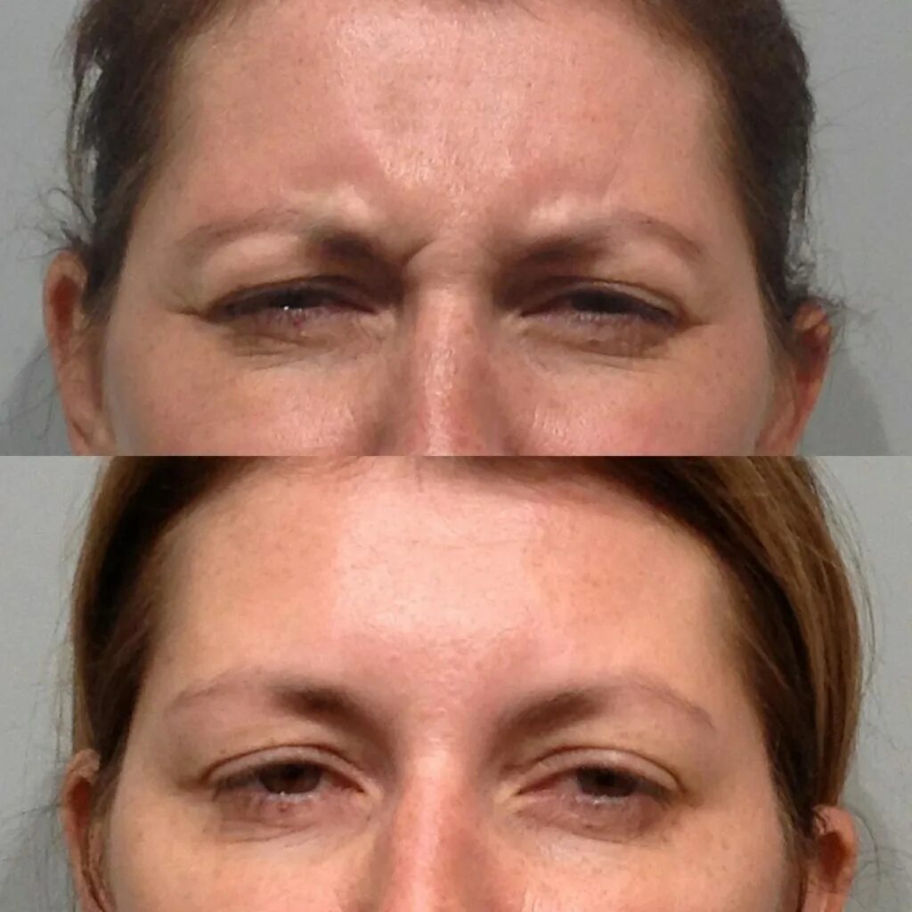 после уколов в когда проходят. после уколов в когда проходят. до и после ботокса лица. морщины на лбу после ботокса. после уколов в когда проходят.