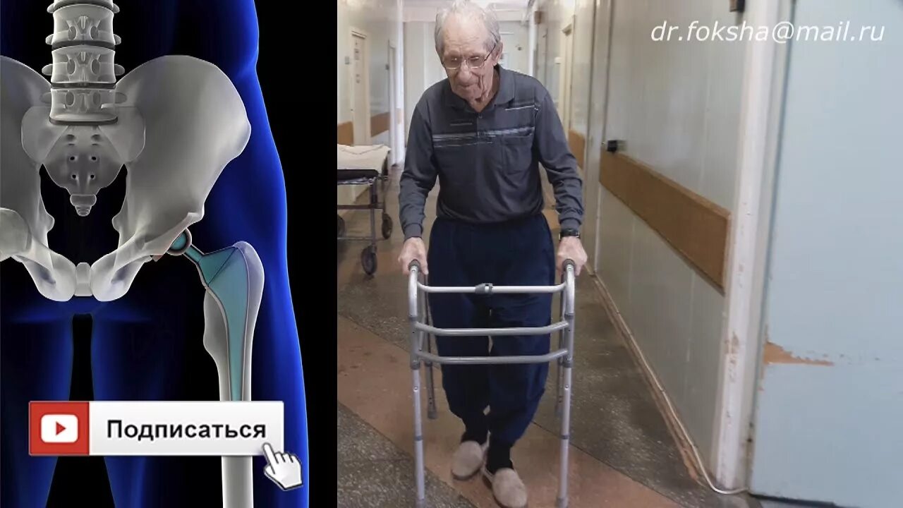 Операция при переломе шейки бедра в пожилом. Перелом шейки бедра реабилитация. Синдром прилипшей пятки при переломе шейки бедра. Реабилитация после перелома шейки бедра в пожилом возрасте. Шейка бедра перелом в пожилом возрасте.