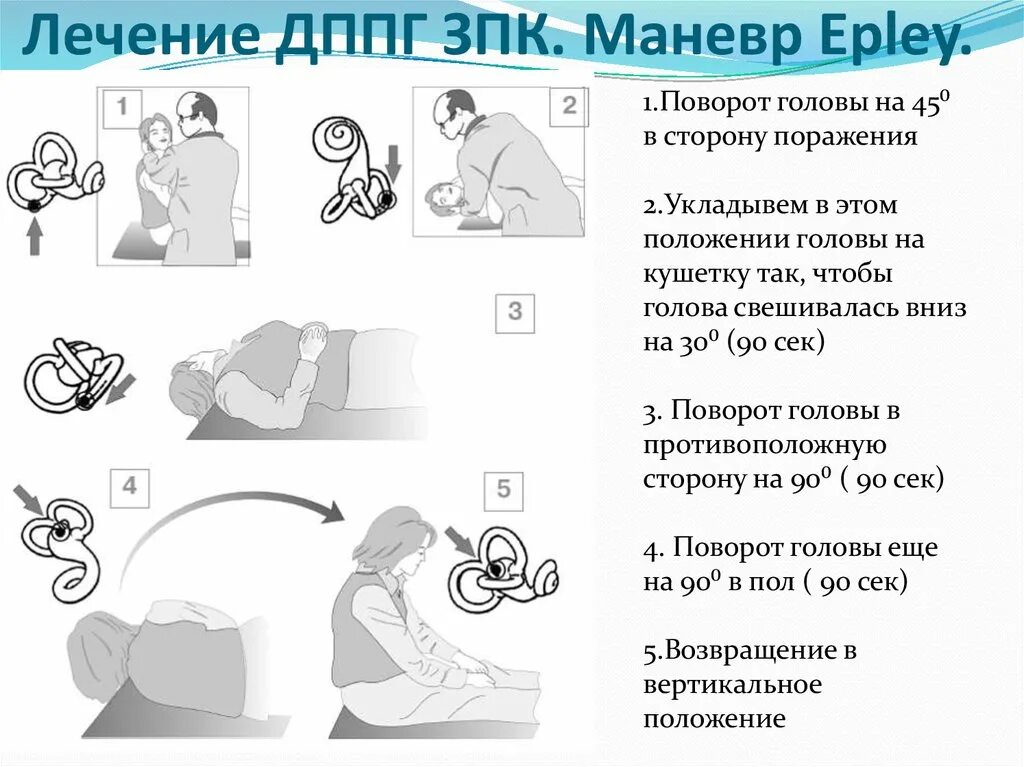 Вестибулярная гимнастика маневр Эпли. Головокружение маневр Эпли. Упражнения при позиционном головокружении. Метод Эпли при головокружении.