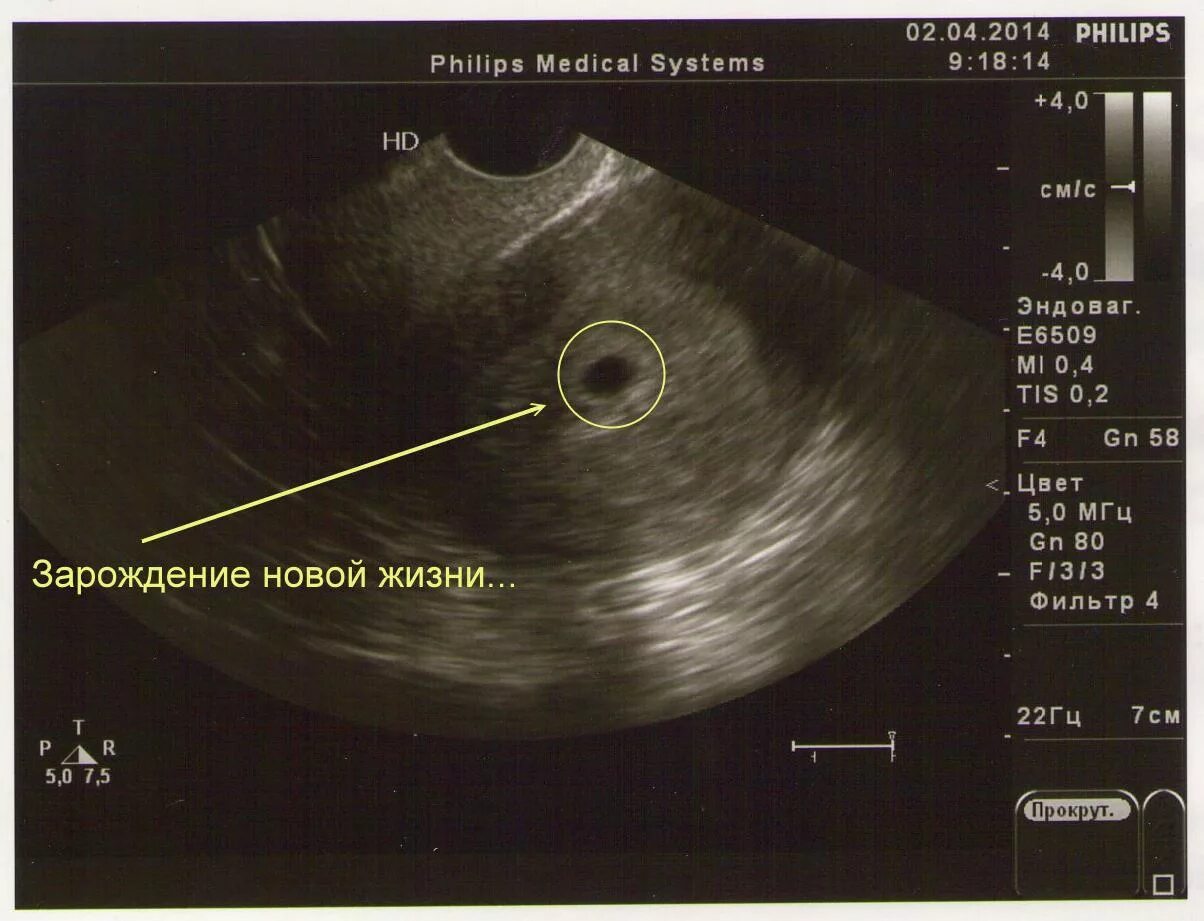 Неделя после зачатия узи. Эмбрион 3-4 недели УЗИ по неделям. Размер эмбриона 2-3 недели. Размер эмбриона на 3 неделе беременности на УЗИ. Размер эмбриона на 4-5 неделе беременности УЗИ.