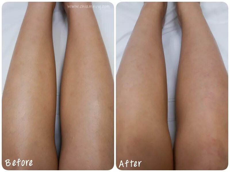 Александритовый лазер кандела. Лазерный эпилятор александритовый. Ноги после лазерной эпиляции. Результаты после эпиляции. Результаты после эпиляции.