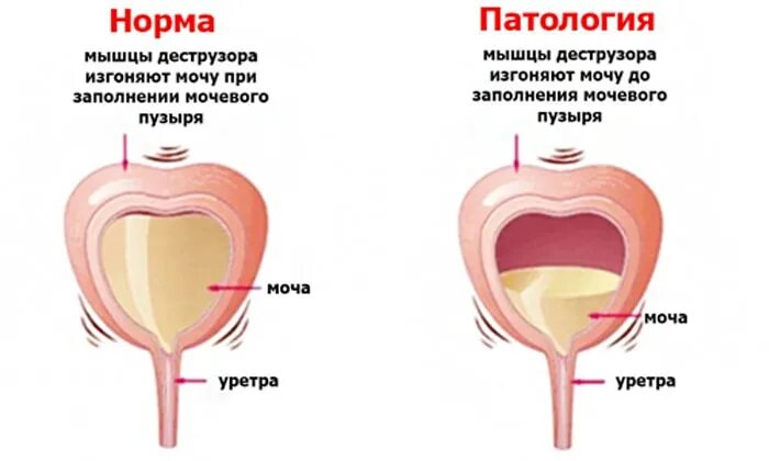 Болит полный мочевой пузырь. Мочевой пузырь. Мочевой пузырь у беременных расположение. Мочеиспускание у женщин. Мочевой пузырь у женщин расположение.