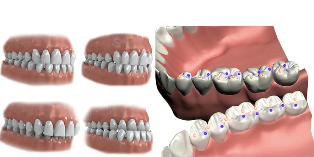 Bite forms