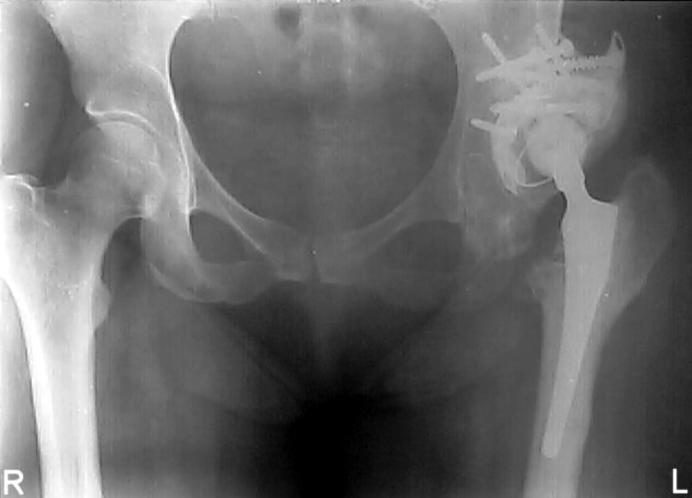 Подвывих эндопротеза тазобедренного. Подвывих эндопротеза тазобедренного. Эндопротезирование тбс вывих. Вывих тазобедренного протеза. Эндопротез тазобедренного сустава рентген протокол.