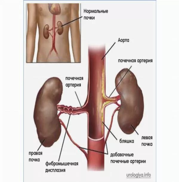 Добавочная почечная артерия. Устье правой почечной артерии. Коленообразная почечная артерия. Почечные артерии анатомия. Правая почка меньше левой