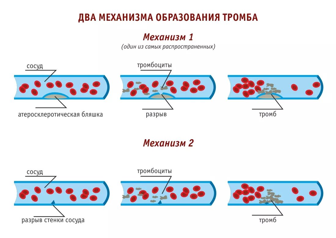 При повреждении сосудов тромбоциты. Механизм образования тромба схема. Образование кровяного сгустка схема. Схема образования тромба. Этапы образования тромба схема.