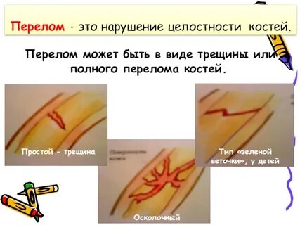 Полный перелом