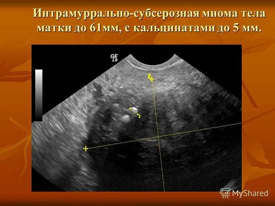 Кальцинированная миома матки на УЗИ. Субсерозная миома матки УЗИ. Субсерозная многоузловая миома матки.