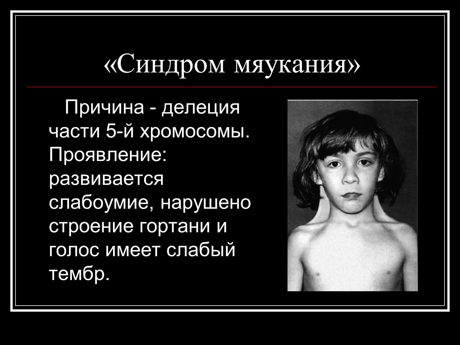 Синдром м р. Дети с синдромом кошачьего крика. синдром кошачьего мяуканья.