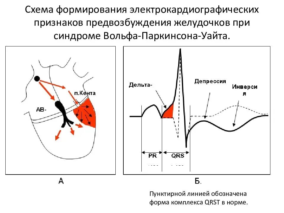 Синдром преждевременного возбуждения желудочков. Экг при синдроме вольфа-паркинсона-уайта wpw. экг критерии впв. синдром впв сердца на экг. впв синдром на экг.