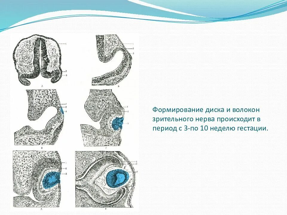 Аномалии развития нерва. Аномалии развития зрительного нерва. Врожденные пороки развития зрительного нерва. Формирование зрительного нерва. Аномалии развития диска зрительного нерва.