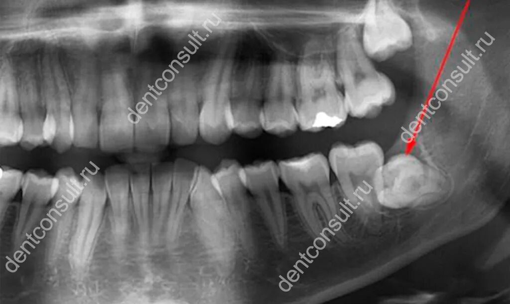 3 5 8 зуб. Ретинированный зуб мудрости рентген. Ретинированный дистопированный зуб мудрости. Ретинированного зуба и дистопированного зуба.