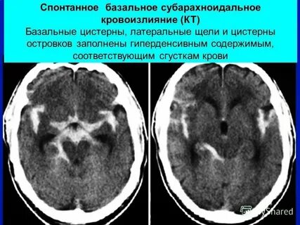 Кровоизлияние в височную долю коры головного мозга