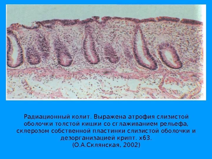 Лечение атрофического колита кишечника. Лечение атрофического колита кишечника. Колиты и энтериты кишечника. Неспецифический язвенный колит (няк). Лечение атрофического колита кишечника.