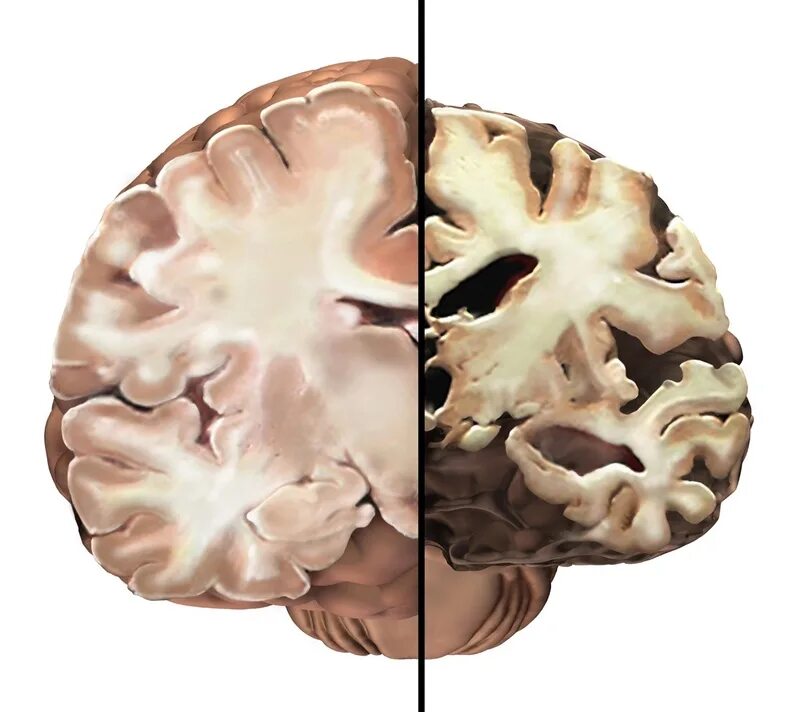 Brain disease. Сенильная деменция головного мозга. Болезнь Альцгеймера. Атрофические изменения коры головного мозга. Атрофия коры головного мозга.