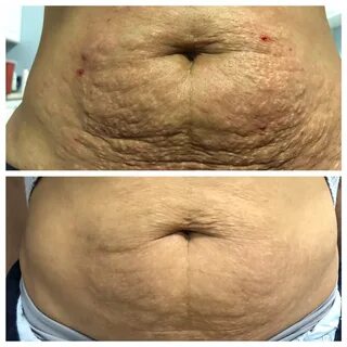 Treat Stretchmarks with RF microneedling & PDO Threads - Dr. Shanthala.