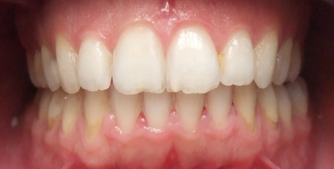 Ниже ниже зубы зубы. Ниже ниже зубы зубы. Стоматология реклама баннер. Ортогнатический прикус моляра. Отбеливание зубов.