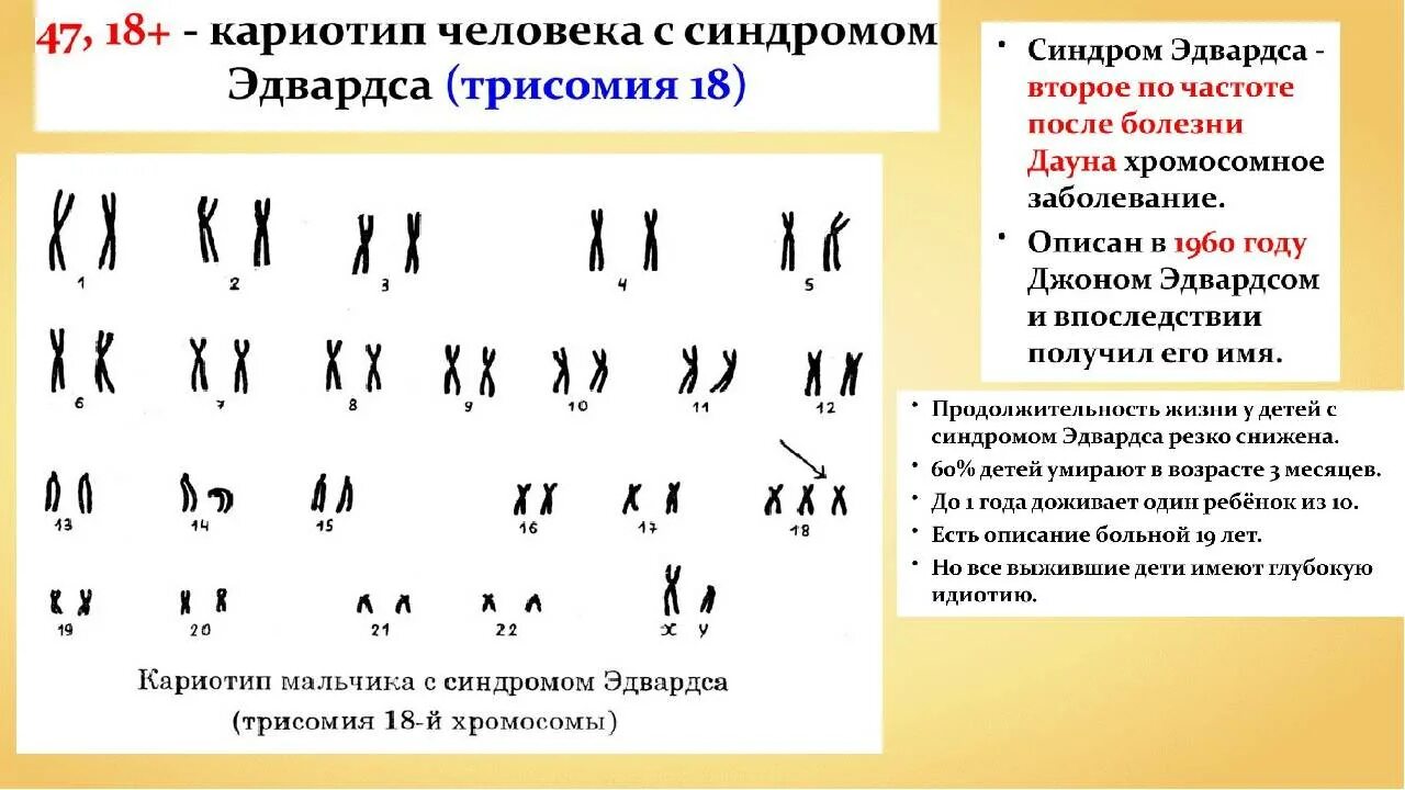 Кариотип собаки включает 78 хромосом определите. Синдром марфана кариотип. синдром марфана кариотип кариотип. кариотип человека с синдромом марфана. синдром дауна кариотип.