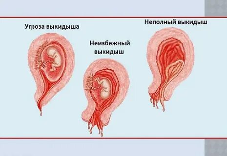 Угрожающий выкидыш