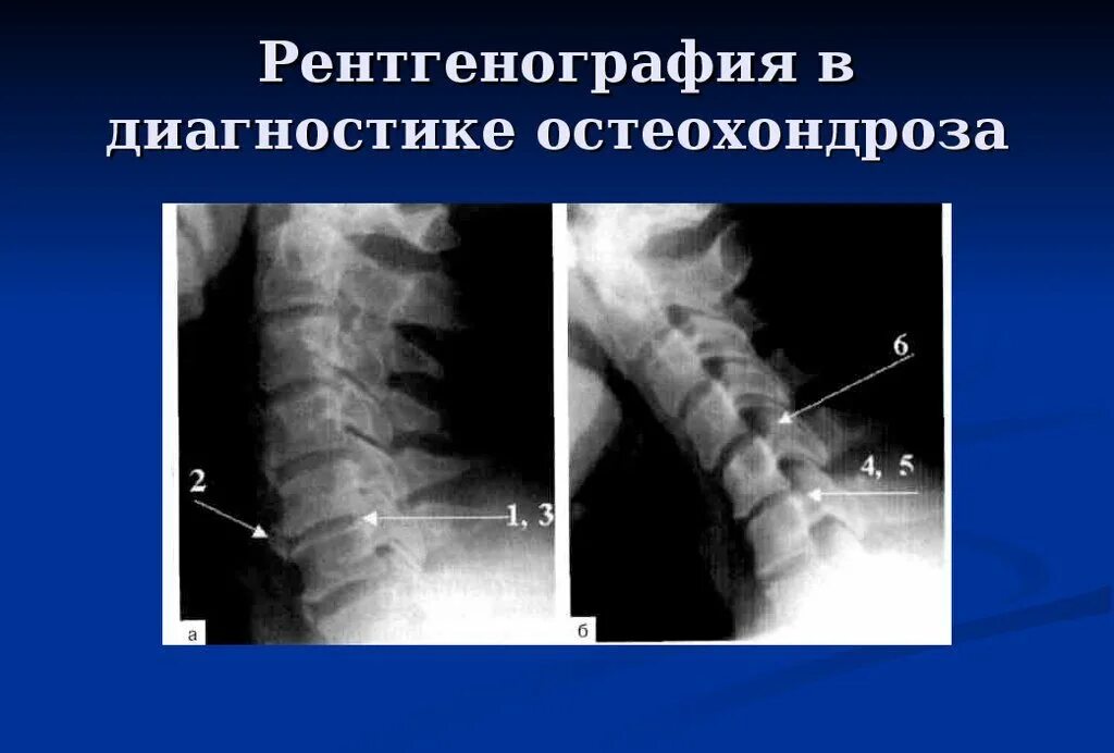 Остеохондроз позвоночника рентген. Остеохондроз шейного отдела на рентгене. Шейный остеохондроз рентген. Остеохондроз шейного отдела позвоночника рентген.