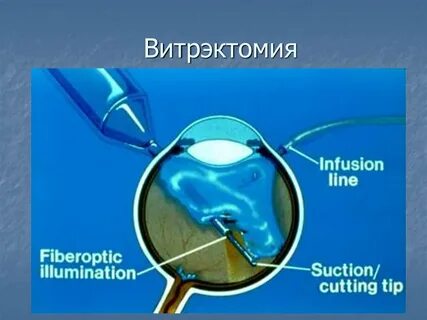 Витрэктомия