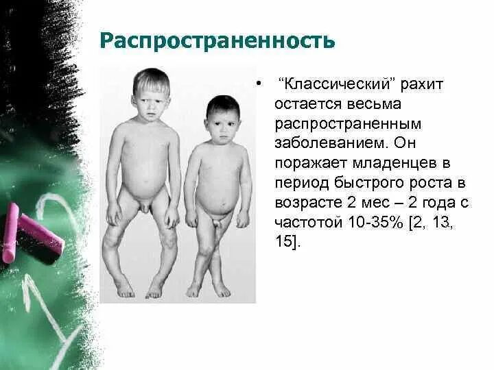 Рахит у детей. Рахит у детей