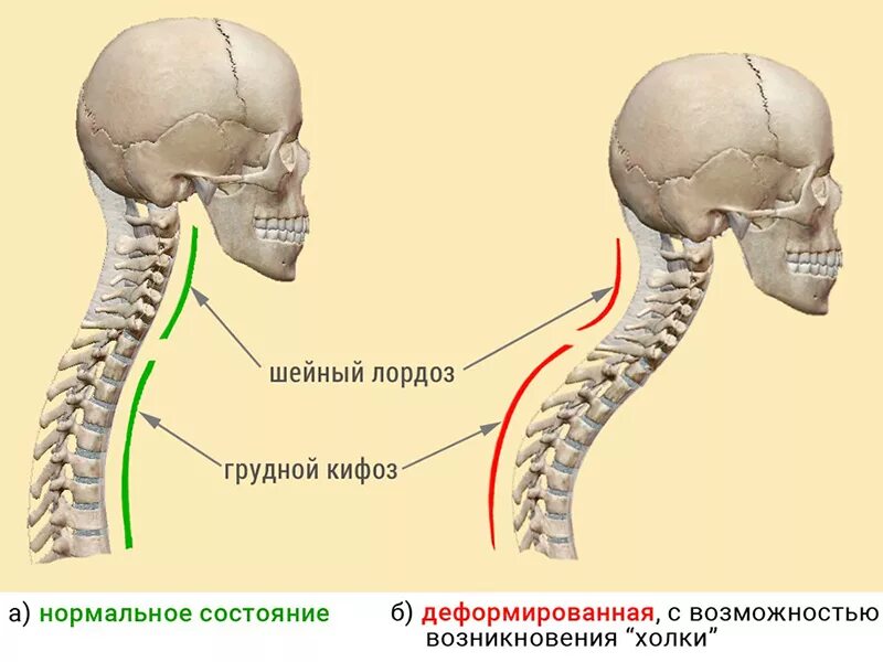 Нарушение статики выпрямление лордоза