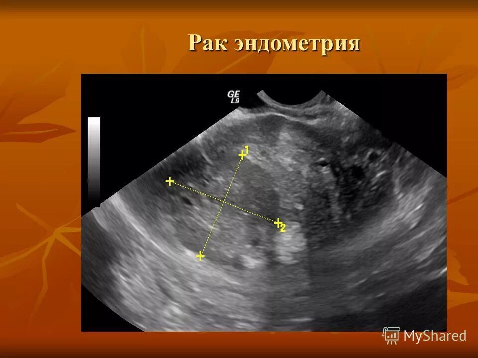 Злокачественное новообразование эндометрия. Карцинома эндометрия на УЗИ. На узи видно рак шейки