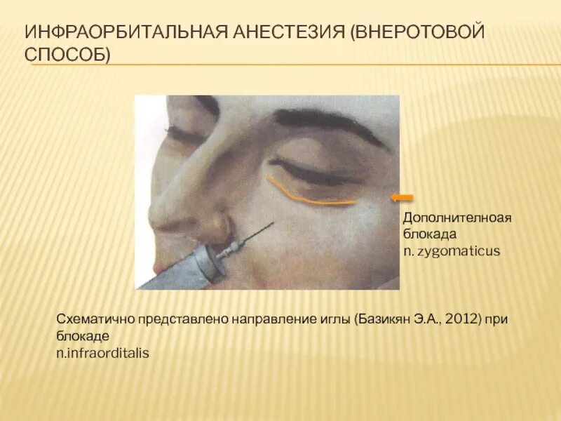 Угол наклона иглы при внутривенных инъекциях:. Направление иглы. Техника пункции перикарда при тампонаде сердца. Внеротовые методы анестезии. Направление иглы.