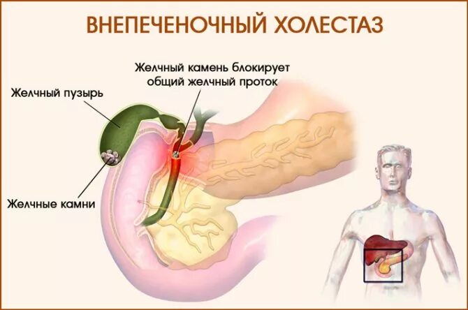 Холестаз и желчный проток. Холестаза желчного пузыря. Застойные явления в желчном пузыре. Внепечёночнфе холестаз.