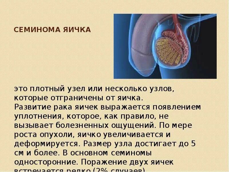 Как выглядит рак яичка у мужчин Как выглядит рак яичка у мужчин фото
