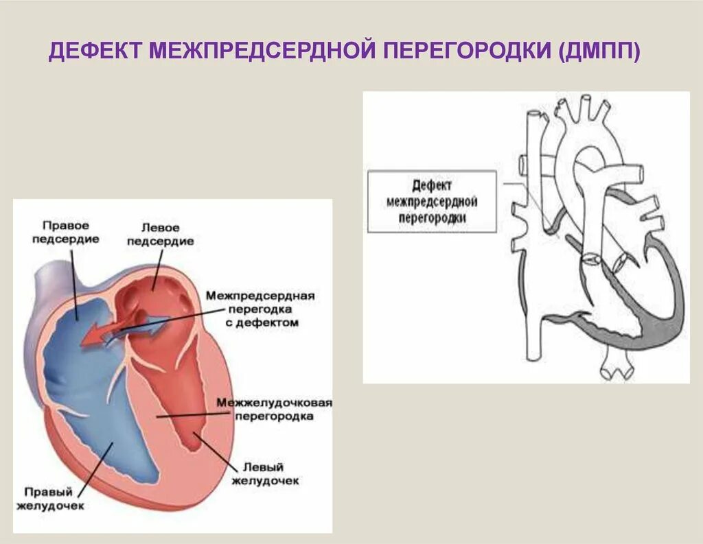 Аневризма перегородки у ребенка. Дефект межпредсердной перегородки гемодинамика рисунок. Дефект межпредсердной перегородки макропрепарат. Порок сердца межпредсердной перегородки. Вторичный дефект межпредсердной перегородки у новорожденного.