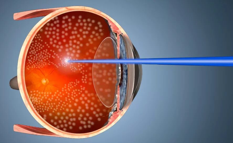 Периферическая лазеркоагуляция сетчатки. Отслойка сетчатки лазеркоагуляция. Решетчатая лазеркоагуляция сетчатки. Транспупиллярная лазеркоагуляция.