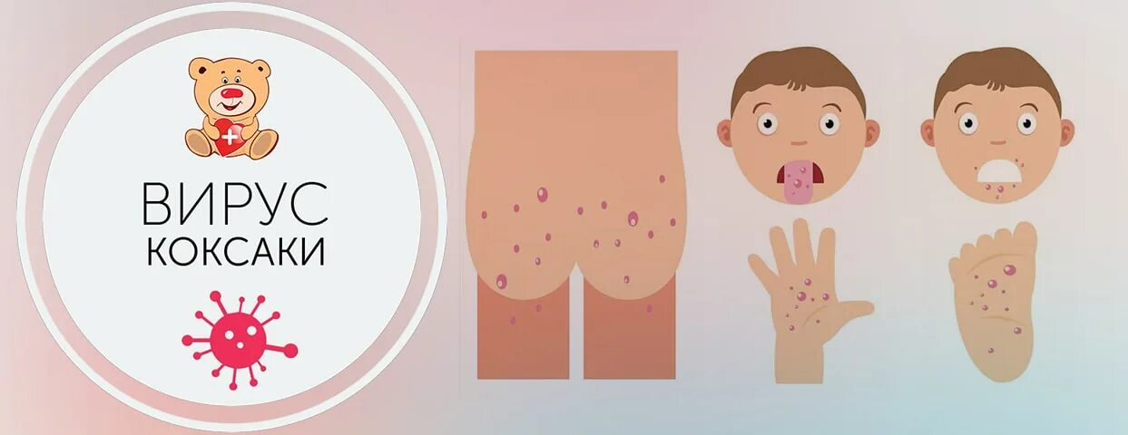 Турецкая ветрянка": как не подцепить вирус Коксаки на курорте Купрум Дзен