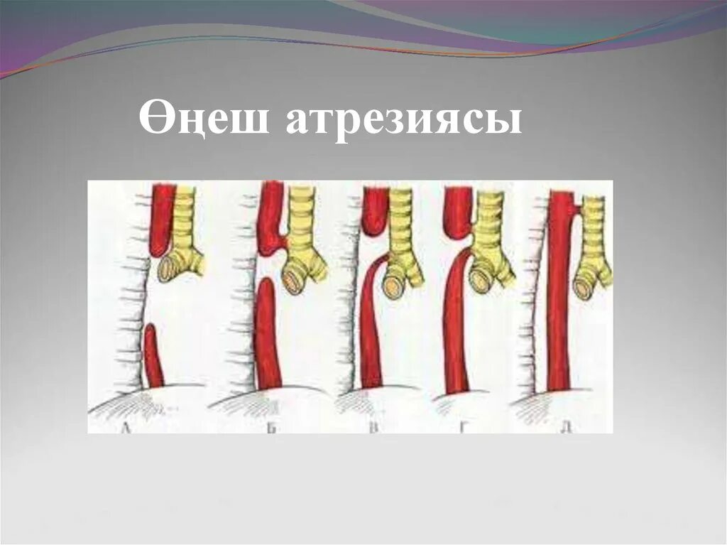 Атрезия пищевода рентген. Атрезия пищевода с трахеопищеводным свищем ?. Врожденная атрезия пищевода. Пищевод у новорожденного