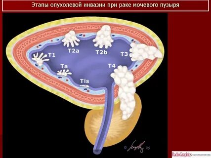 Химиотерапия мочевого пузыря