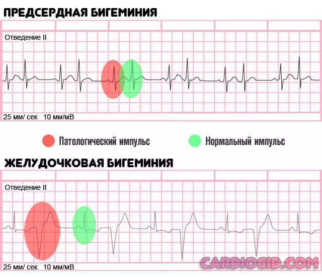 Желудочковые экстрасистолы бигеминия на экг. Тригеминия сердца. Бигеминия сердца на экг. Наджелудочковая экстрасистолия бигеминия экг. Экг желудочковая экстрасистолия аллоритмия.