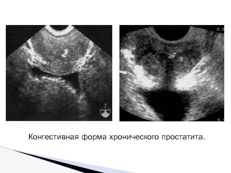 Простатит гиперплазия. Трансректальное УЗИ простаты. Гиперплазия предстательной железы УЗИ.