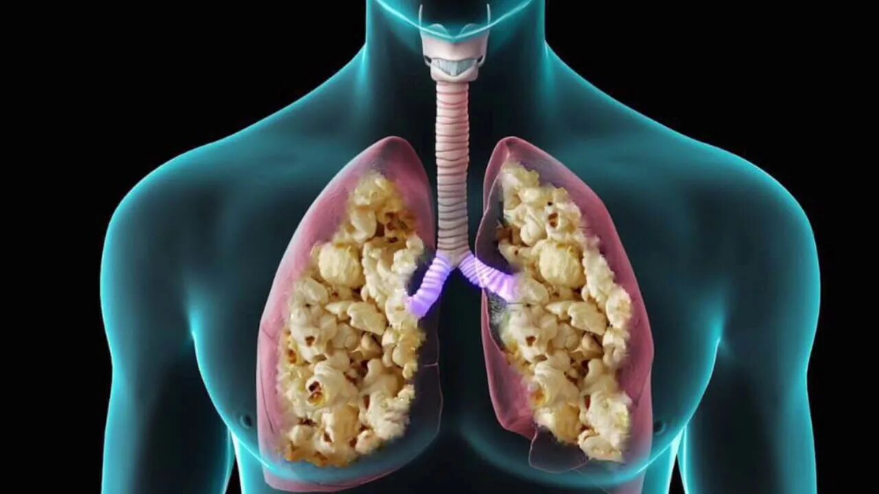 Попкорная болезнь легких.