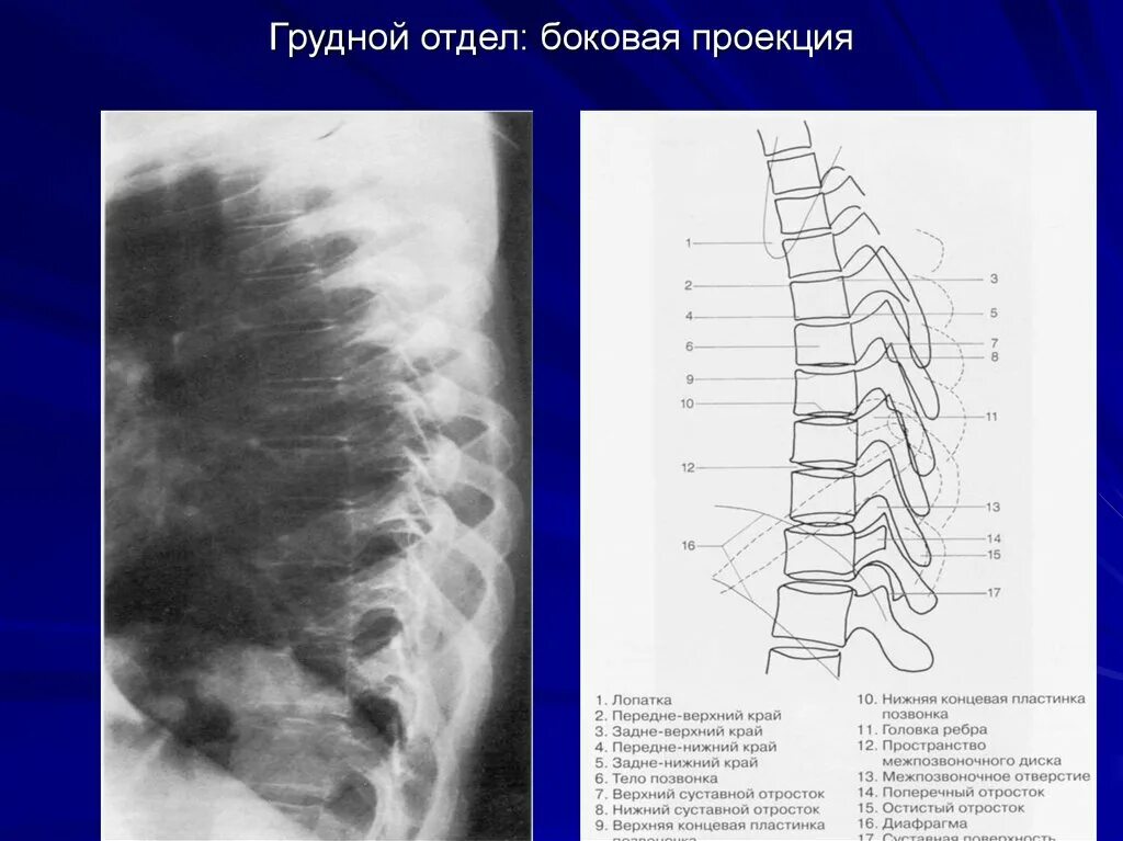 Изменения боковых отделов. Поясничный отдел рентген сбоку нормальный. Рентген грудного отдела сбоку. Грудной отдел позвоночника спереди.