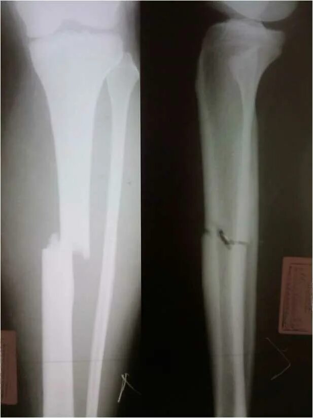 Перелом большеберцовой кости рентген. Поперечный перелом большеберцовой кости рентгенограммы. Перелом малой берцовой кости. Диафизарный перелом малой берцовой.