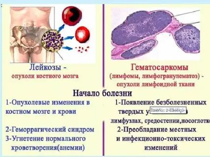 Иммунный лейкоз